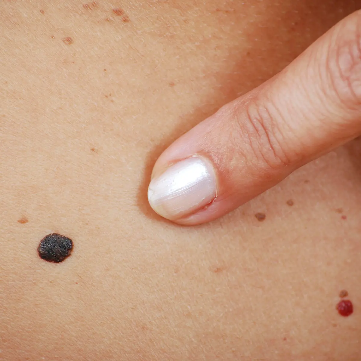 Muttermal (Leberfleck) Logo von Muttermal (Leberfleck)