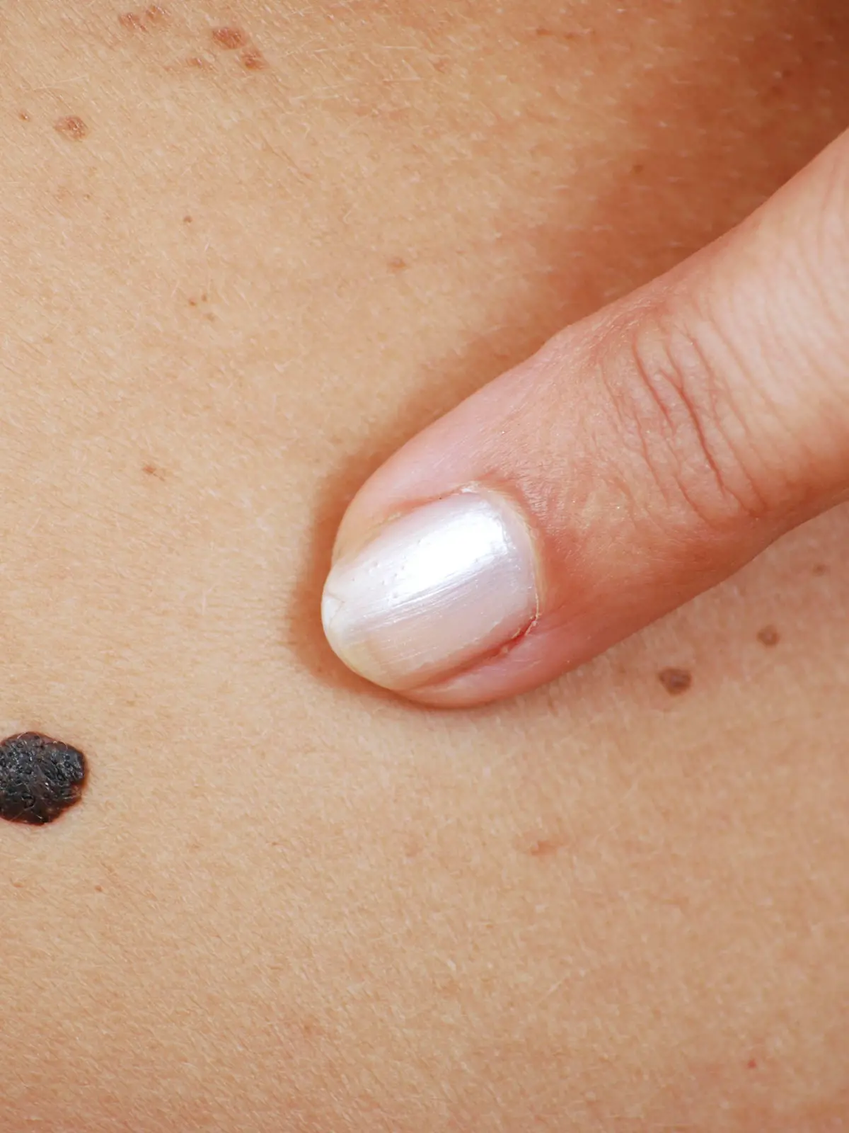 Muttermal / Leberfleck, schwarzes Melanom, Finger, Hautkrebs, Haut