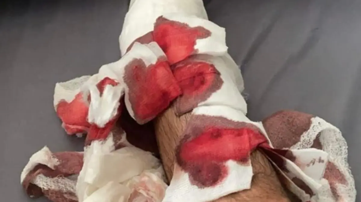 Juan Manuel Correa zeigt erstmals nach dem Unfall sein rechtes Bein ohne Fixateur