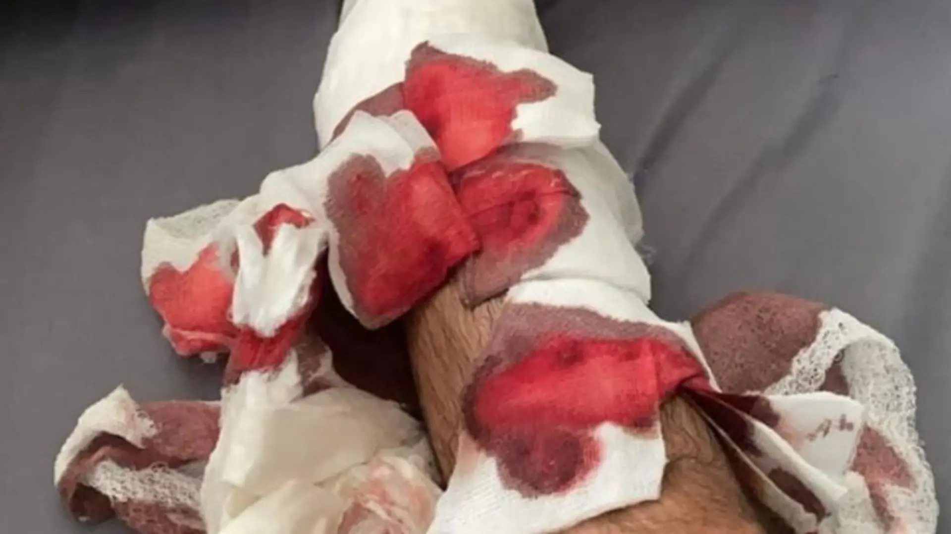 Juan Manuel Correa zeigt erstmals nach dem Unfall sein rechtes Bein ohne Fixateur