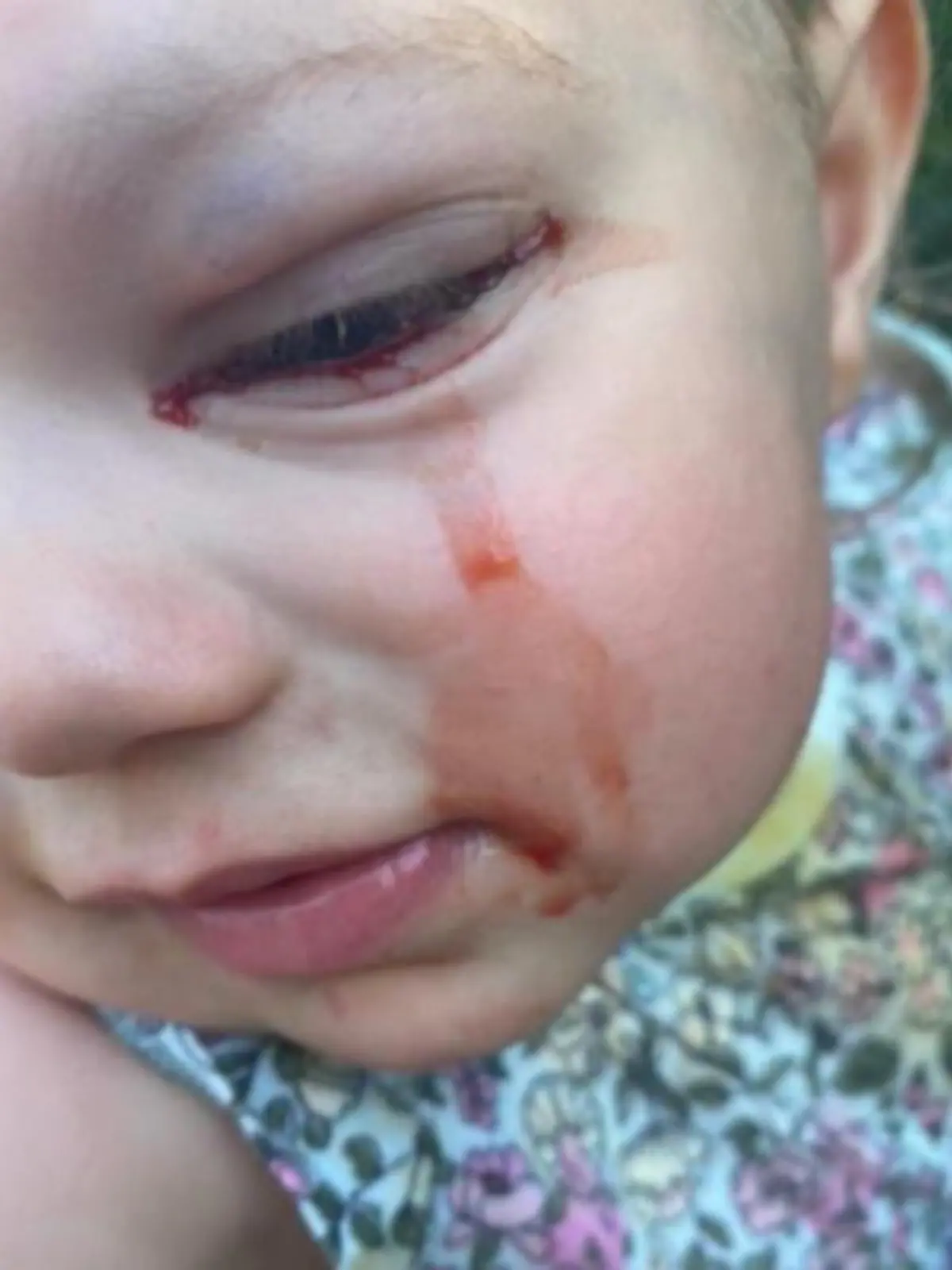 Der 22 Monate alten Millie aus England kullern rote Tränen über ihre Wange. Der Grund ist eine Zyste hinter ihrem linken Auge, die sie Blut weinen lässt. Im Video zeigen wir, wie es der Kleinen heute geht.