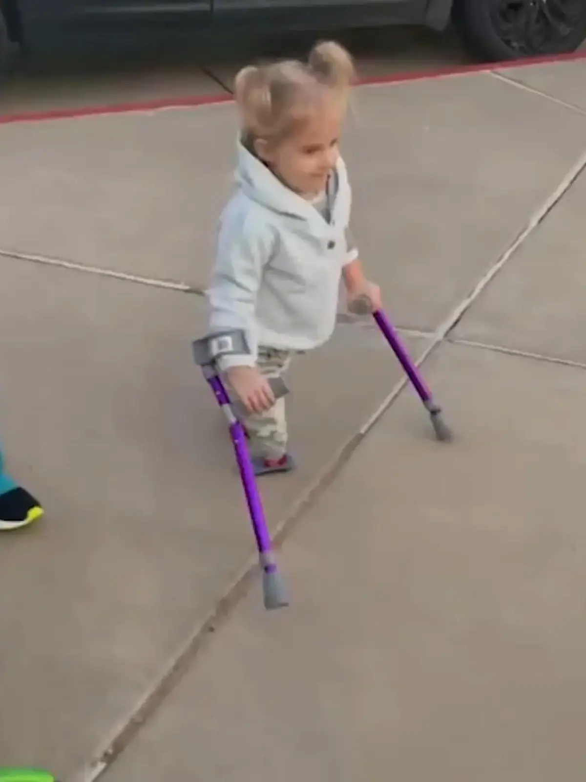 Die kleine Blaire Spivey aus Lubbock in Texas in den USA ist ein echtes Wunder und beweist schon mit ihren fünf Jahren, dass sie eine echte Kämpferin ist. Das Mädchen wird mit Sirenomelie geboren, auch Meerjungfrauen-Syndrom genannt. In einer mehrstündigen OP müssen die Unterschenkel amputiert werden. Ärzte glauben erst nicht, dass das kleine Mädchen überhaupt überleben würde, doch Blaire beweist es allen. Ihre ersten Schritte sehen Sie im Video.