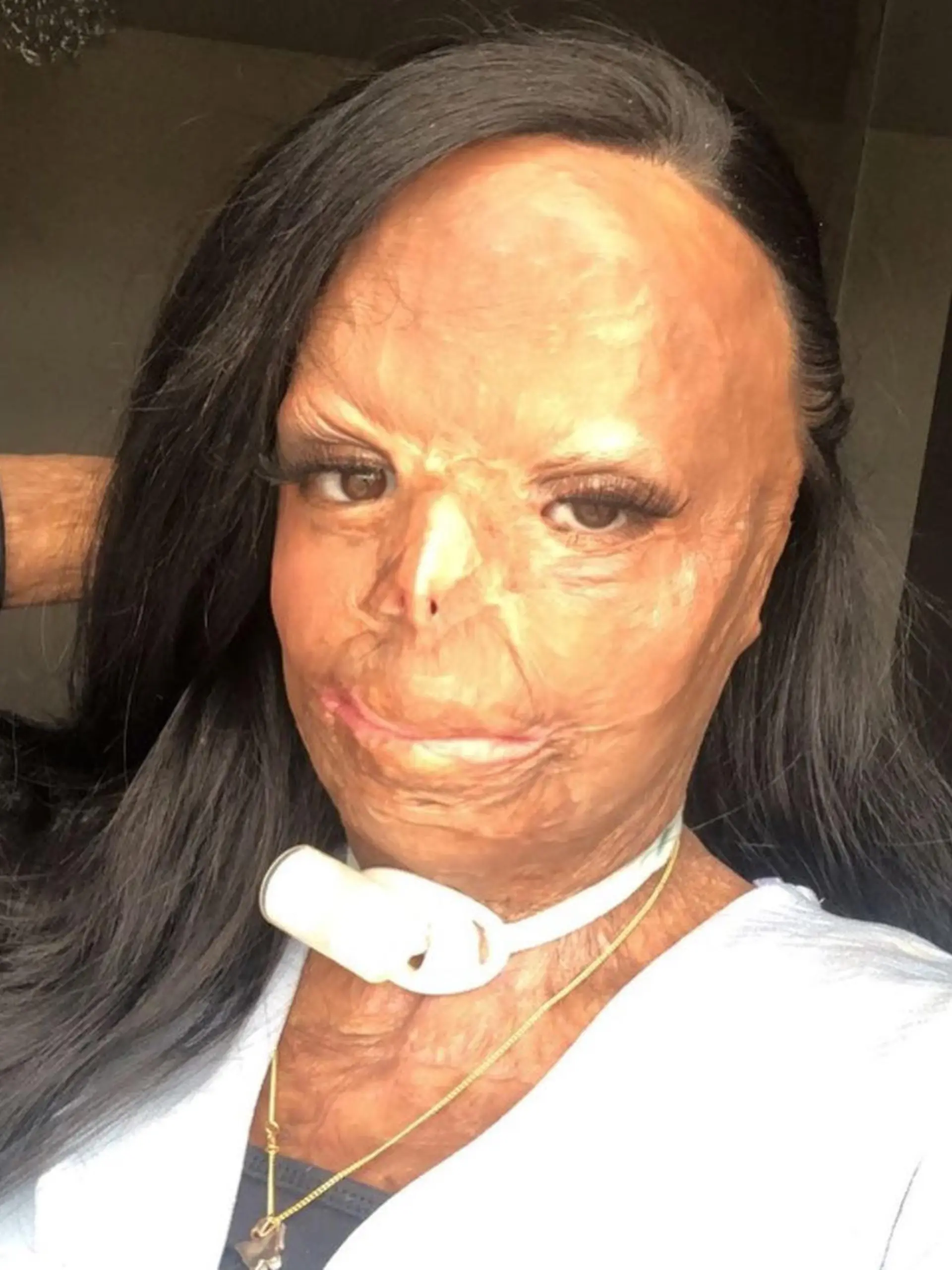 Mädchen mit Verbrennungen im Gesicht.
