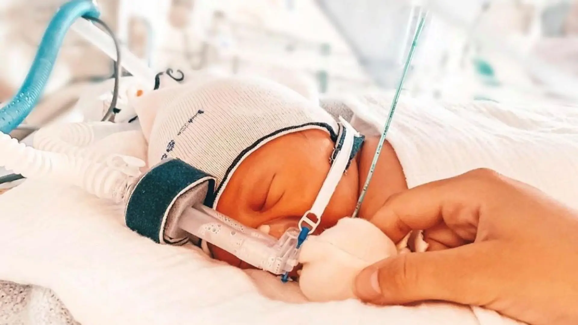 Baby Bruno kam mit Loch im Rücken zur Welt