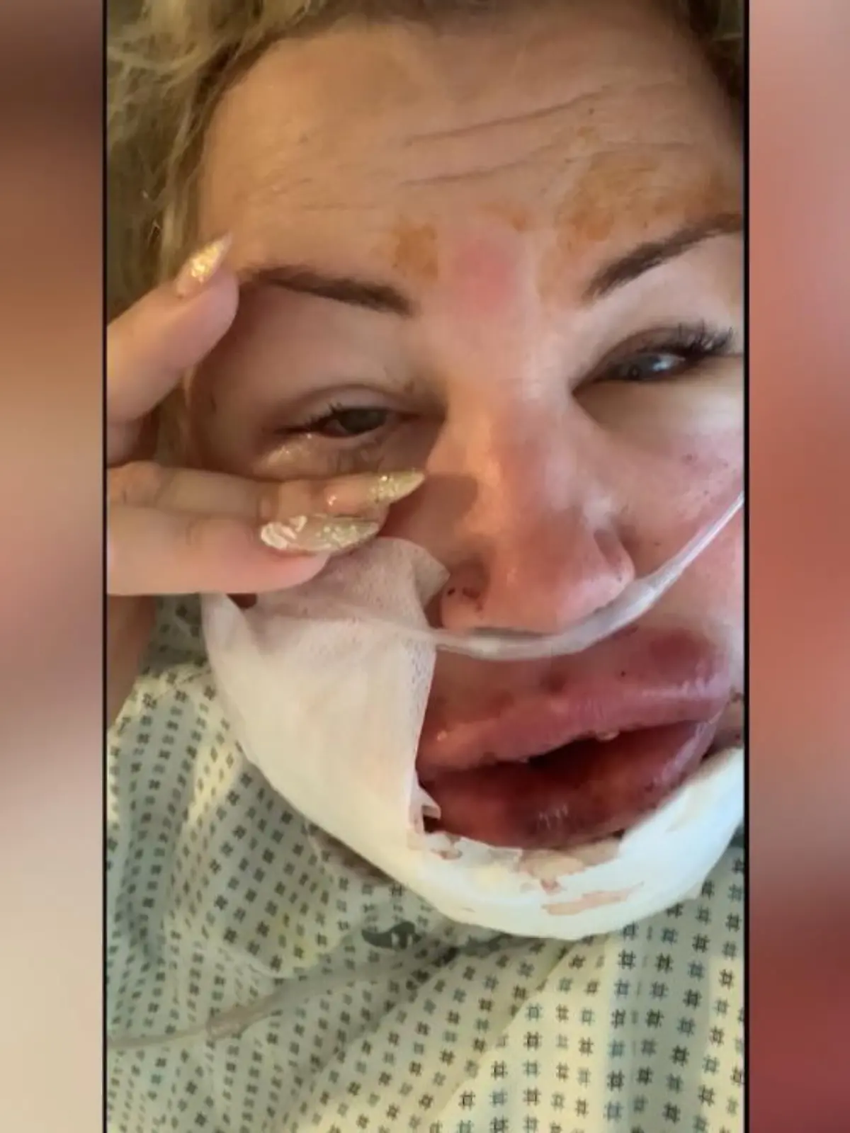 Bianca Cicciarella-Vella wollte nur jünger aussehen. Dafür ließ sie sich einige Falten mit Hyaluron unterspritzen. Doch die Behandlung ging schief und die Unternehmerin kämpft seit Wochen mit den Folgen des Eingriffs. Jetzt will sie andere Frauen warnen.