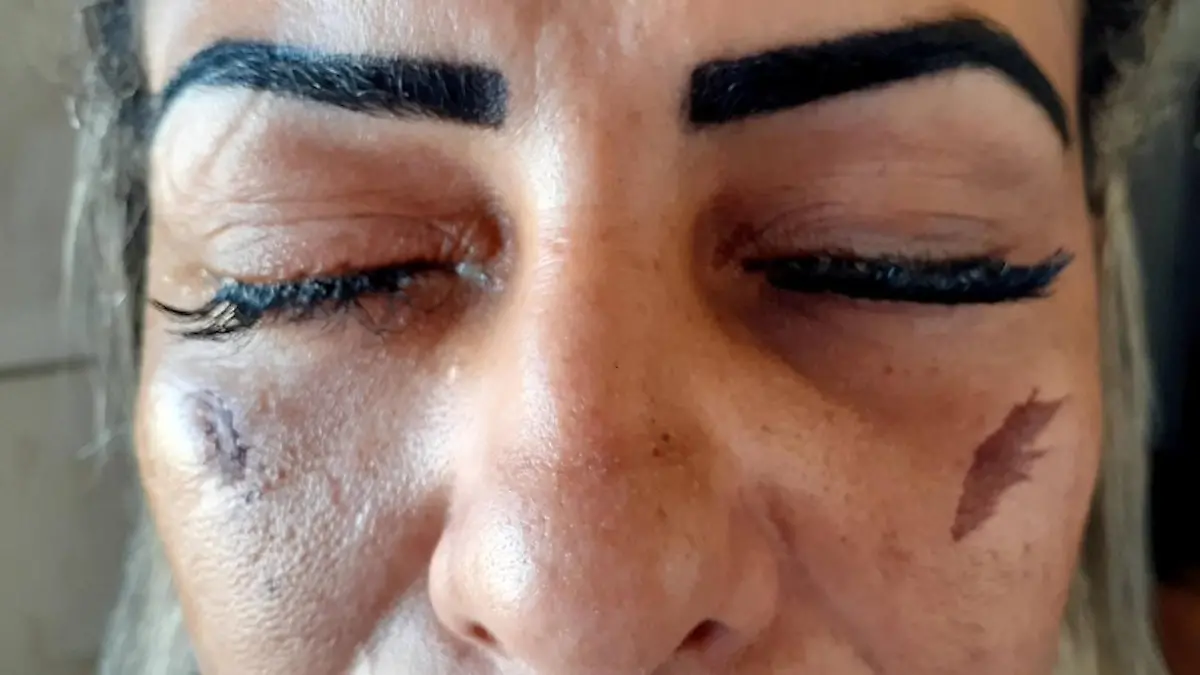 Frau geriet Wimpernkleber in die Augen