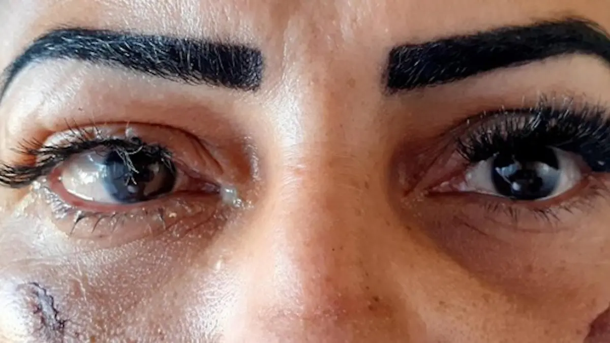 Frau fast  blind, nachdem Wimpernkleber in die Augen gerät