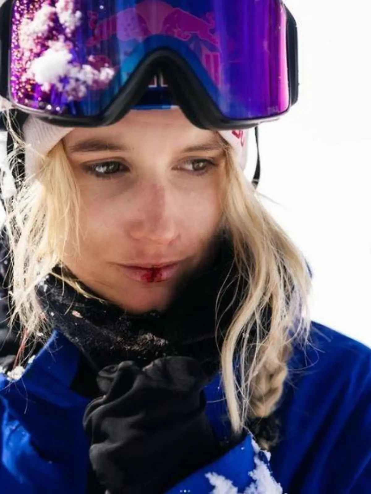 Anna Gasser hat sich bei einem Sturz die Lippe augfeschlagen.