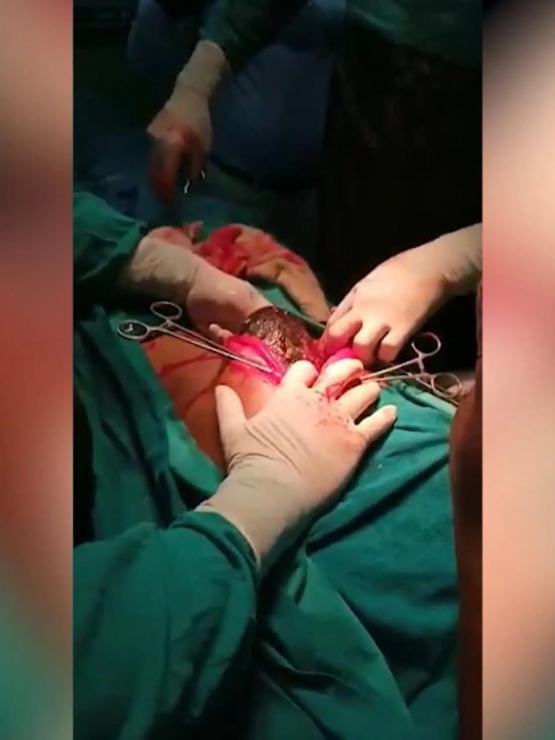 Im Video zeigen wir die spektakuläre Operation eines gigantischen Haarbündels.