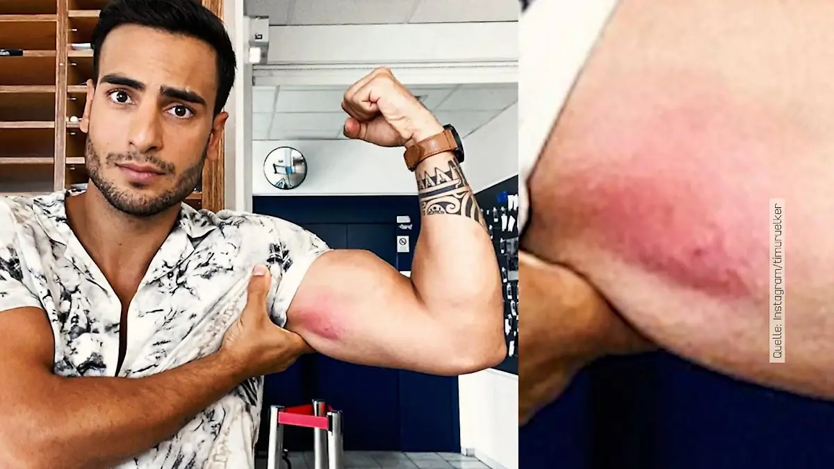 Timur Ülker von Wespe „durchlöchert“ Fieser Stich im Arm