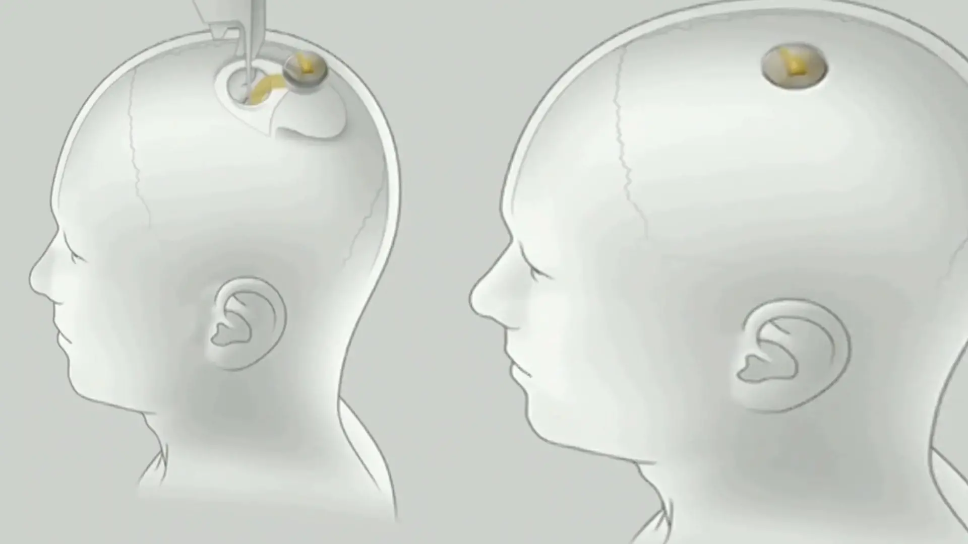 Gehirn-Chip von Neuralink