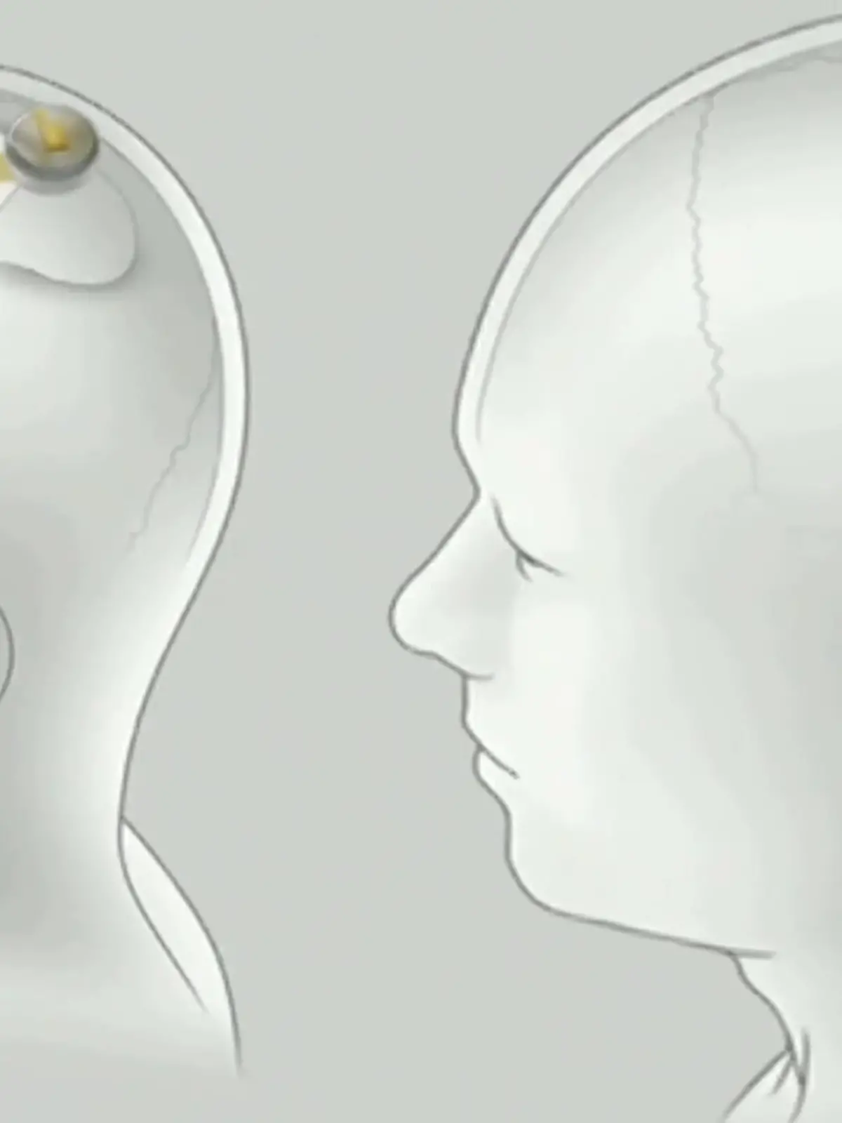 Gehirn-Chip von Neuralink