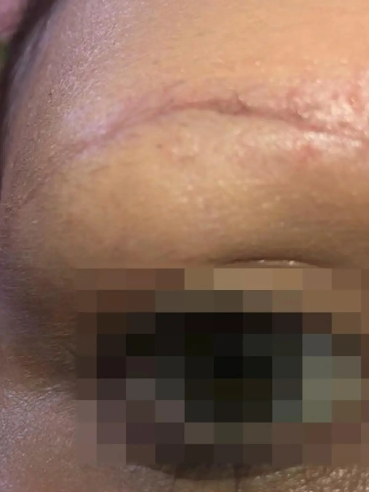 Fünf Frauen leiden bis heute unter den entstellenden Folgen dieser "Kosmetik"-Behandlung: Bei der Entfernung von Permanent-Make-up an den Augenbrauen erlitten sie teils schwere Verätzungen. Die Narben zeigen, wie schmerzhaft das gewesen sein muss. Jetzt wurde die verantwortliche Kosmetikerin wegen Körperverletzung verurteilt.