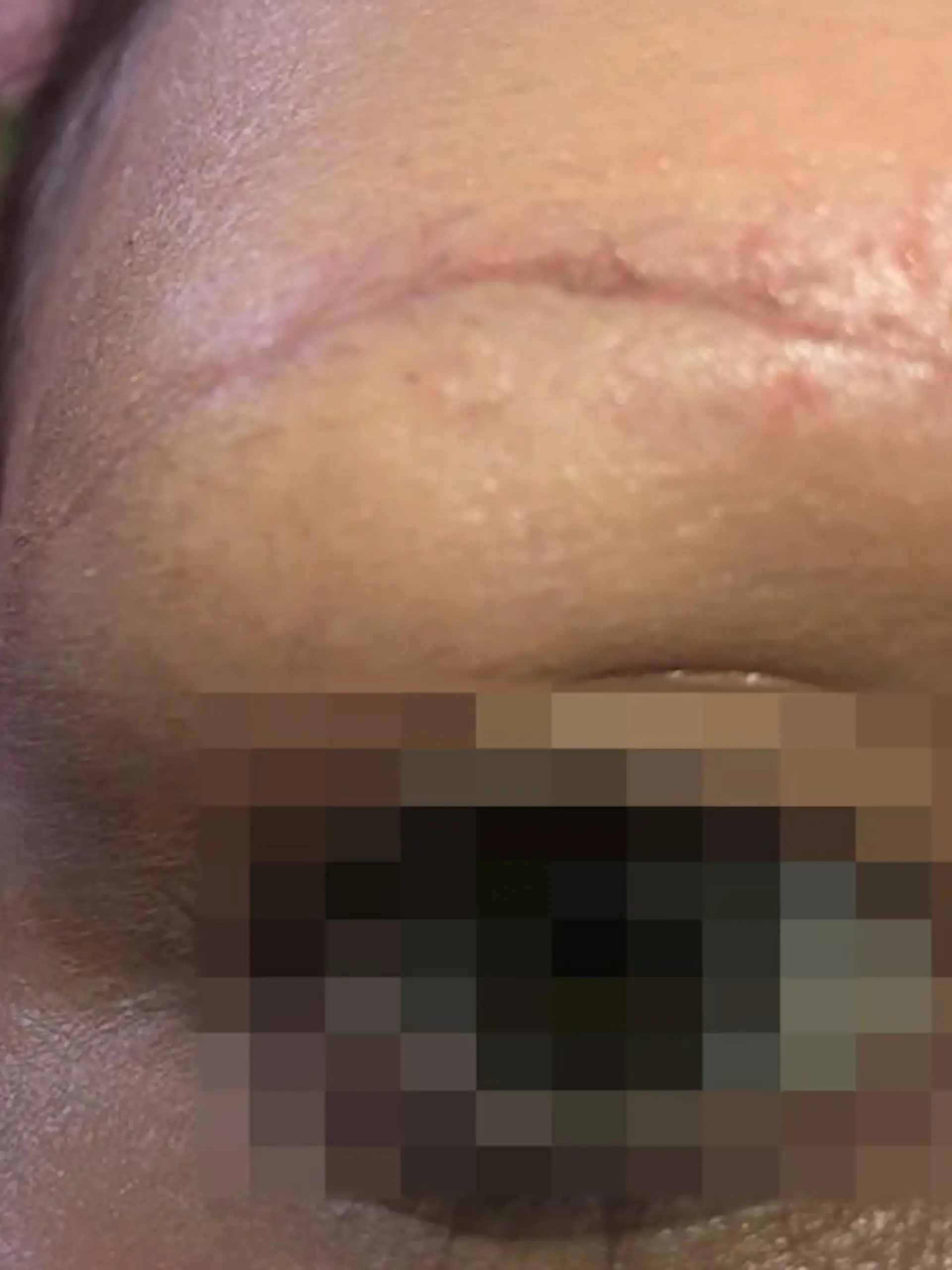 Fünf Frauen leiden bis heute unter den entstellenden Folgen dieser "Kosmetik"-Behandlung: Bei der Entfernung von Permanent-Make-up an den Augenbrauen erlitten sie teils schwere Verätzungen. Die Narben zeigen, wie schmerzhaft das gewesen sein muss. Jetzt wurde die verantwortliche Kosmetikerin wegen Körperverletzung verurteilt.