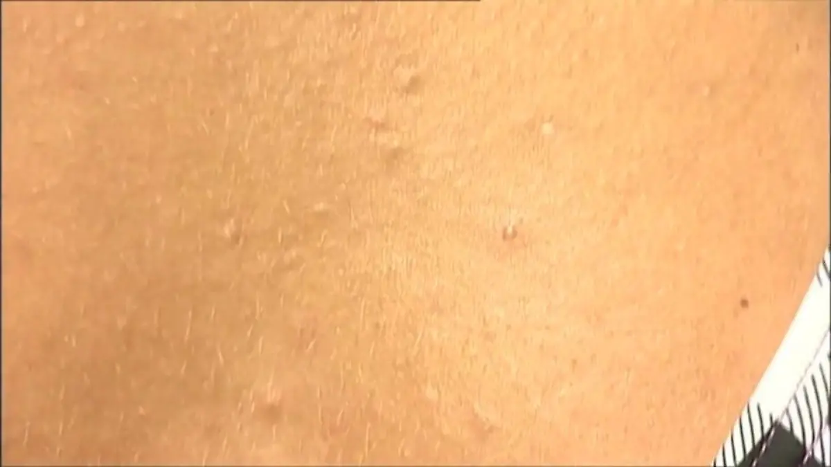 Sonnenallergie: So kann man sich schützen Wenn es nach dem Sonnenbad juckt