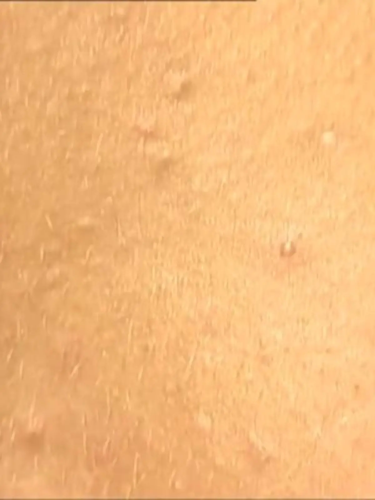 Bild zu: "Sonnenallergie: So kann man sich schützen"