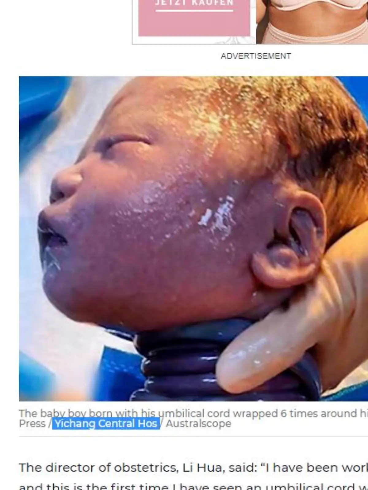 Baby kommt mit sechsfach um den Hals gewickelter Nabelschnur zur Welt