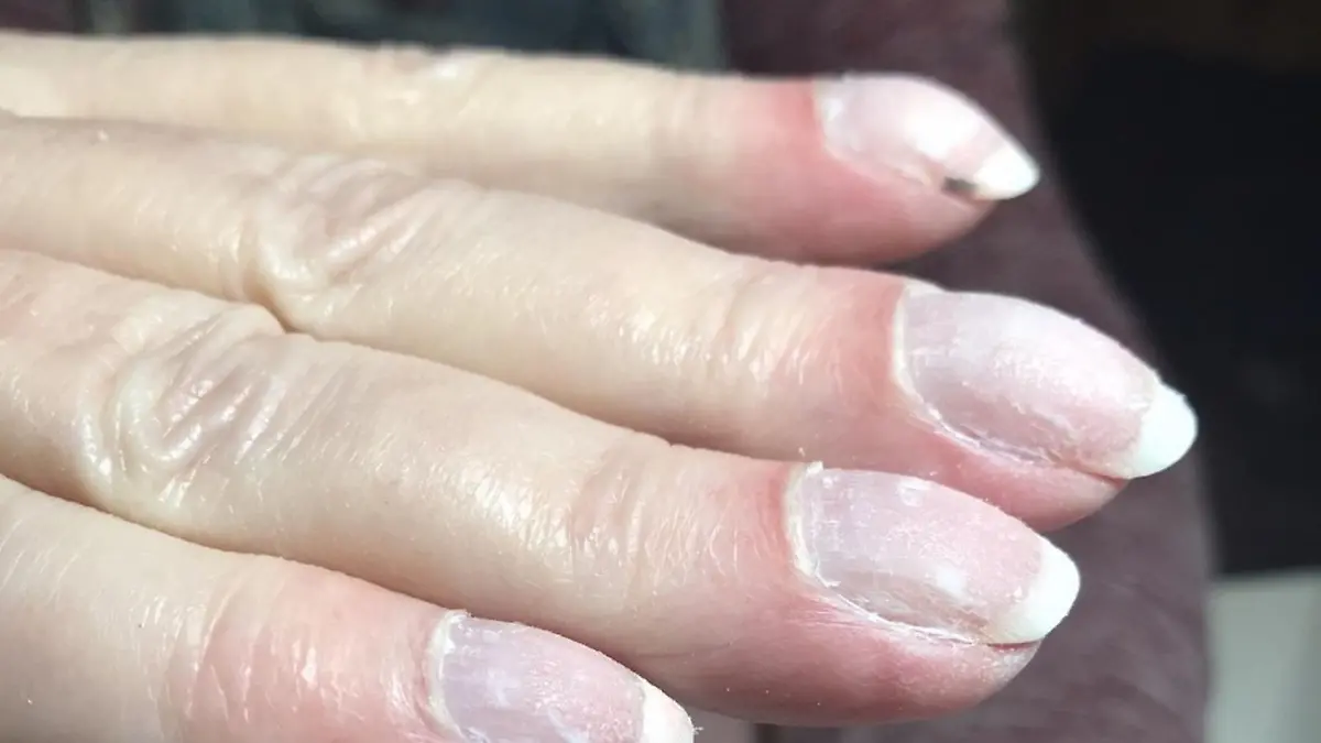 Fingernagel mit schwarzem Hautkrebs