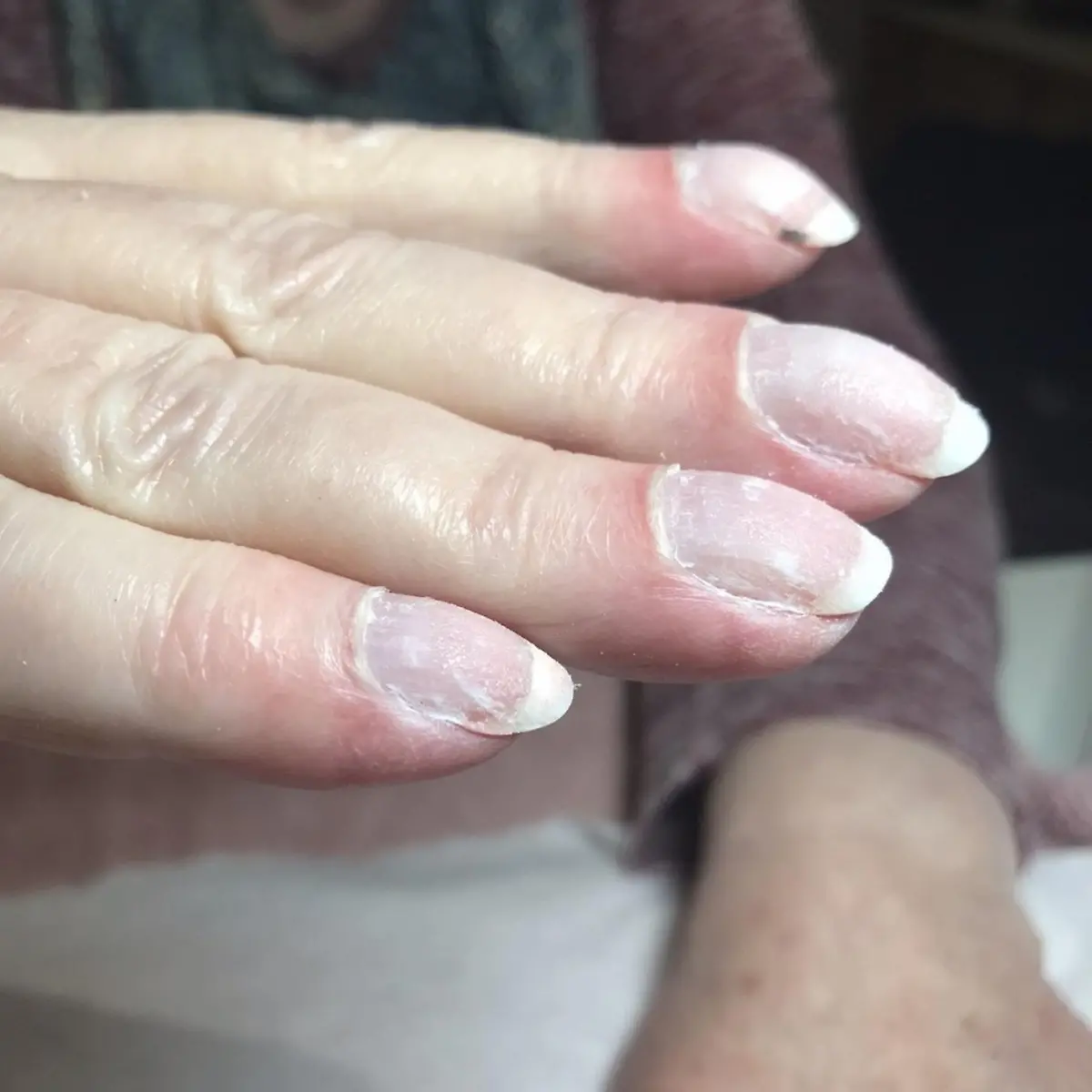 Lungenkrebs bei Manikre entdeckt: Nagelpflegerin rettete Joans Leben