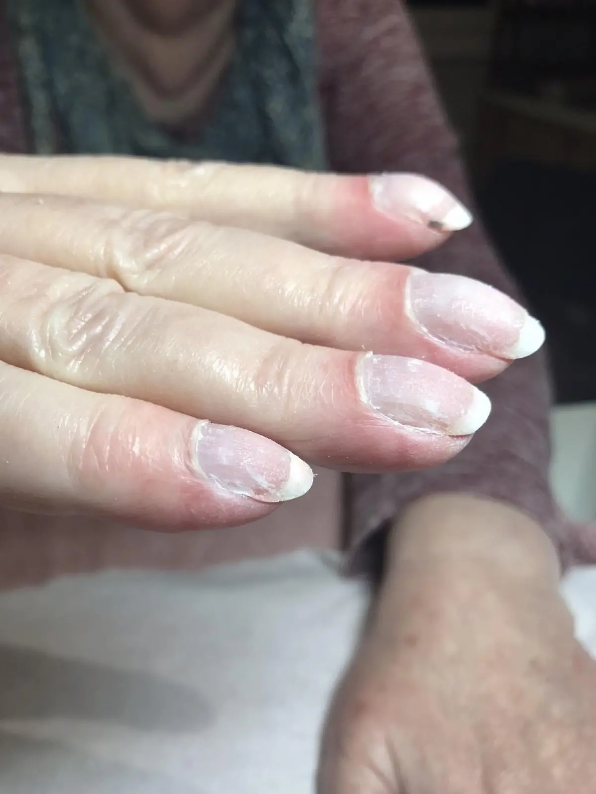 Fingernagel mit schwarzem Hautkrebs