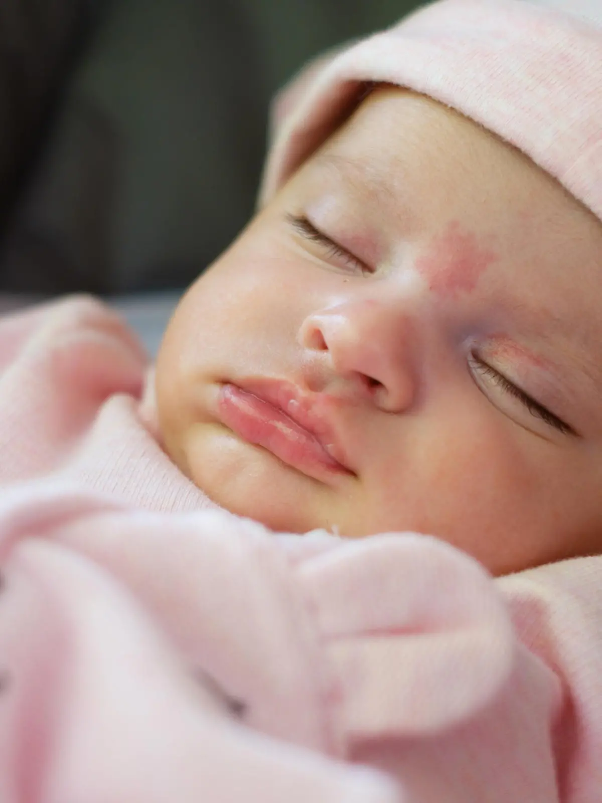 Baby mit Geburtsmal im Gesicht