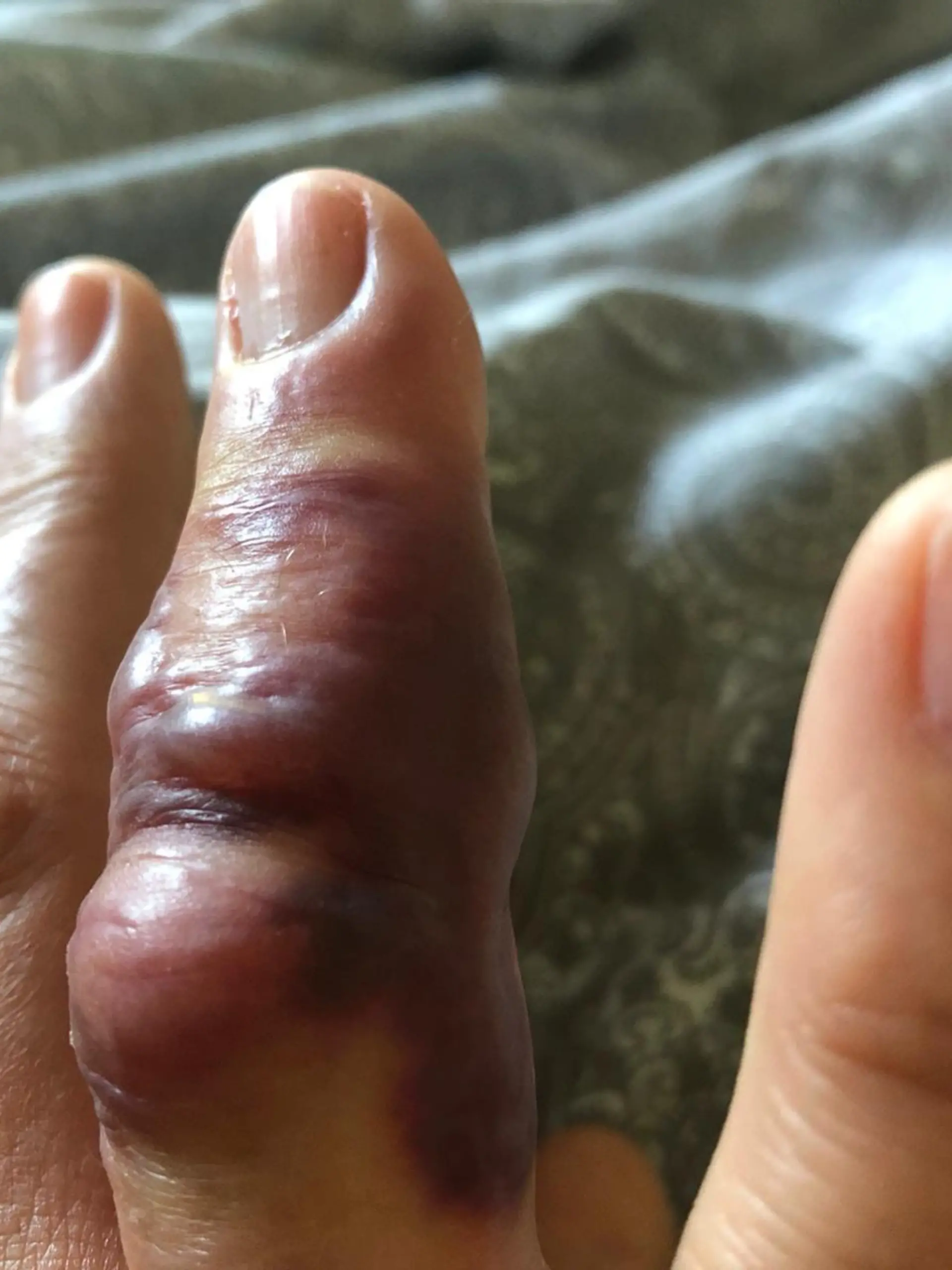 Giselas Finger nach dem Stich
