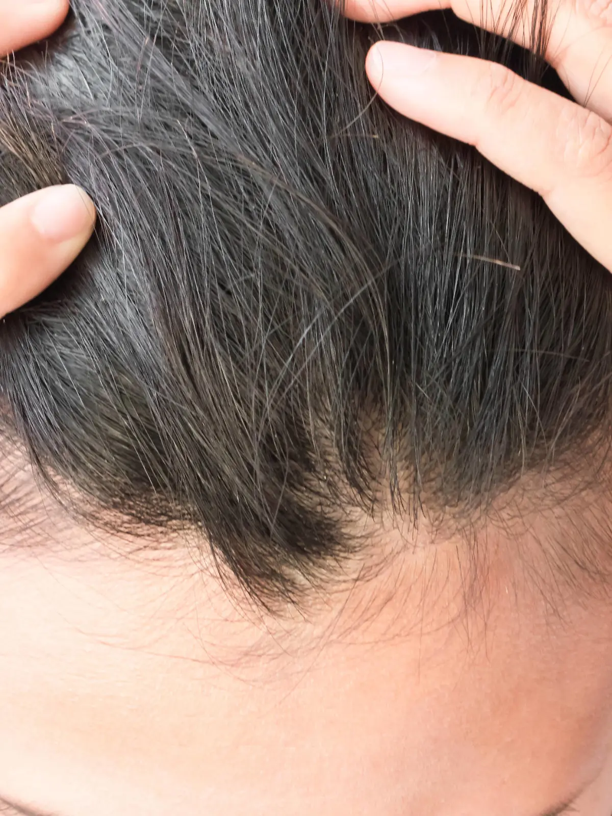 Woman serious hair loss problem for health care shampoo and beauty product concept Copyright: xx 24985692