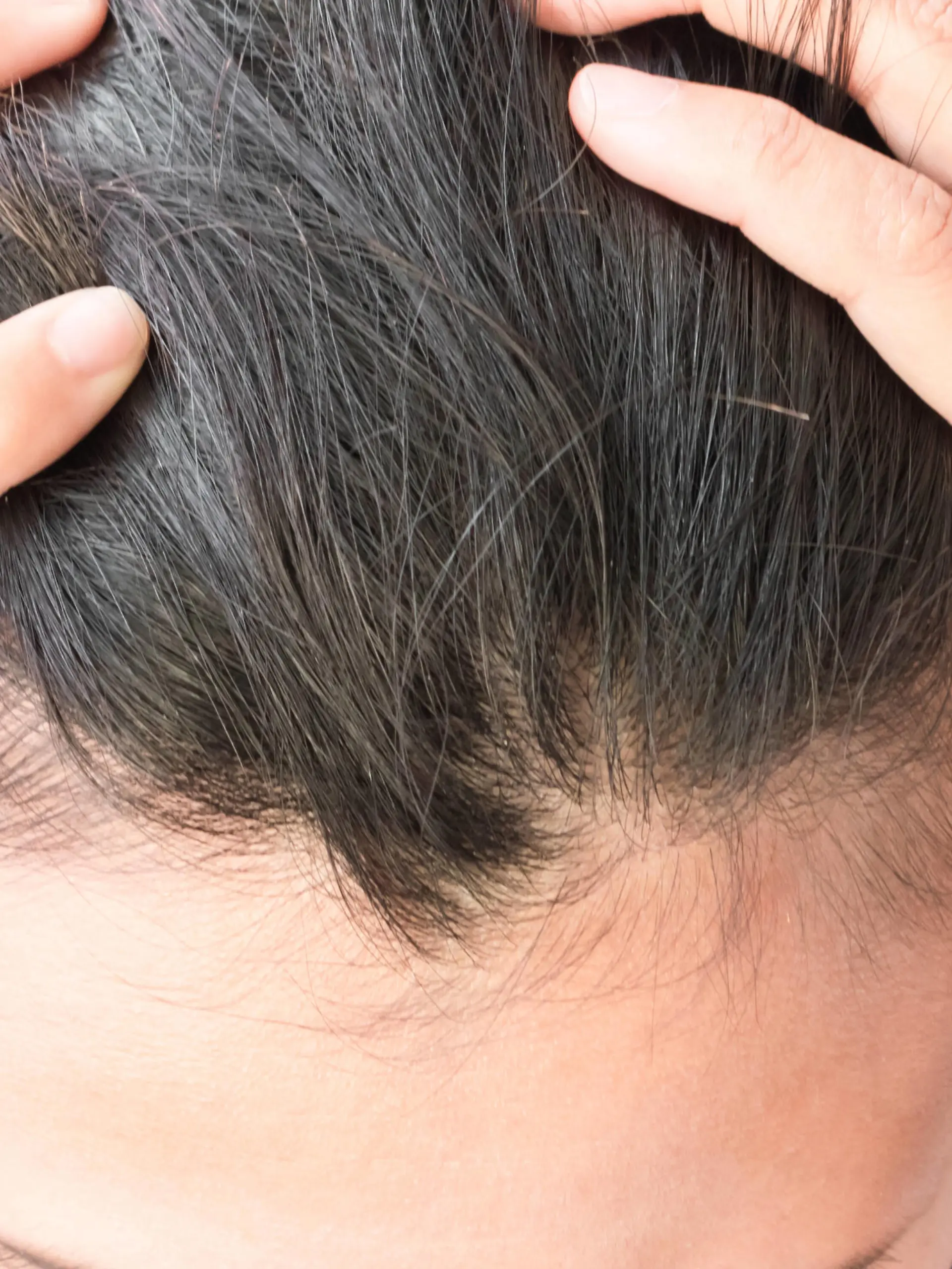 Woman serious hair loss problem for health care shampoo and beauty product concept Copyright: xx 24985692