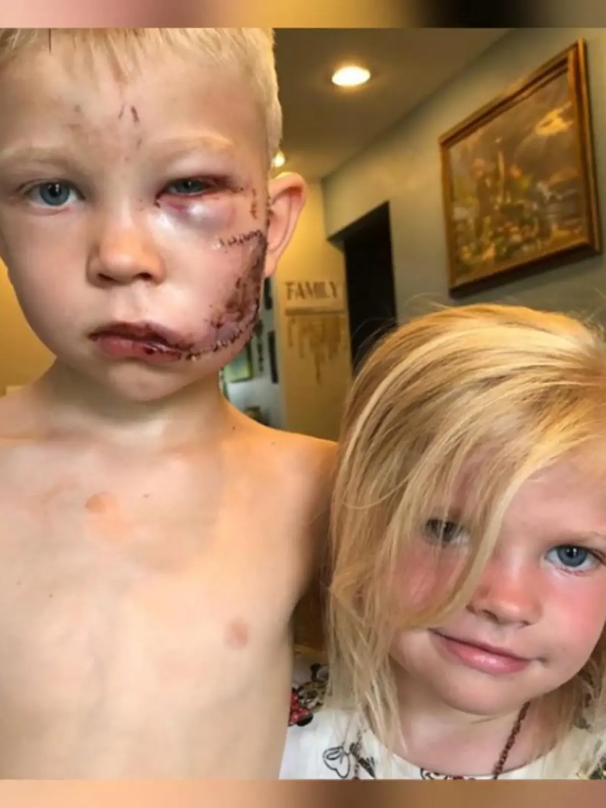 In Wyoming beweist der 6-jährige Bridger Walker was Geschwisterliebe für ihn bedeutet und opfert sich anstelle seiner kleinen Schwester im Kampf gegen einen bissigen Hund.  Wie er die Heldentat überstanden hat, zeigen wir im Video.