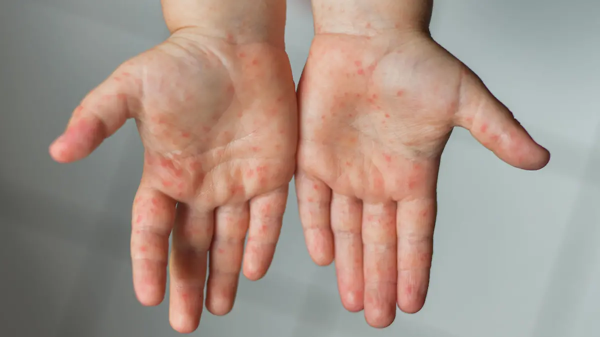 Kind zeigt Hände mit Hand-Fuß-Mund-Krankheit
