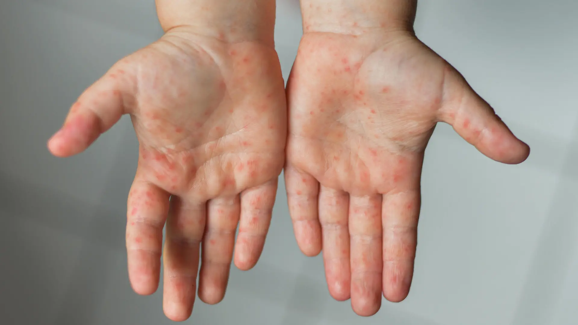 Kind zeigt Hände mit Hand-Fuß-Mund-Krankheit