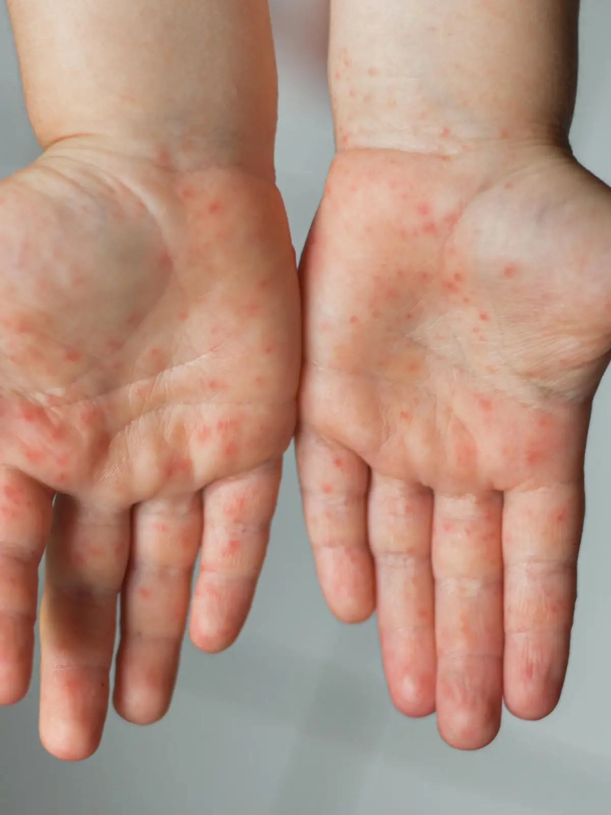 Kind zeigt Hände mit Hand-Fuß-Mund-Krankheit