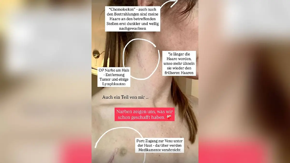Patrice Aminati zeigt ihre Narben.