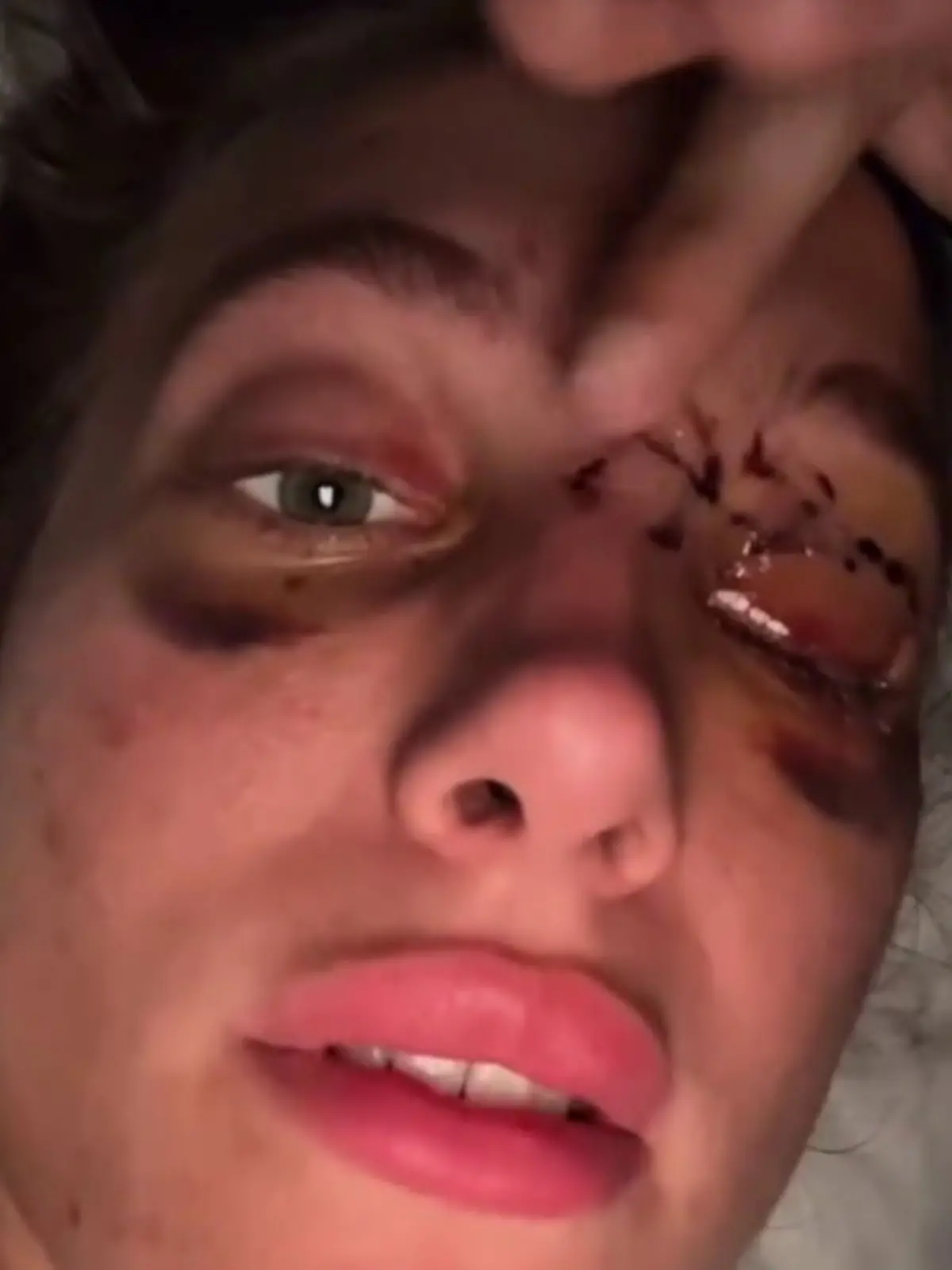 Mercedes Valentine verliert bei einem Motorradunfall fast ihr Leben.