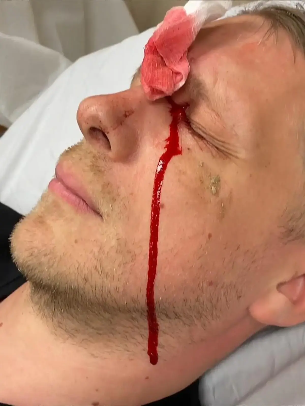 Oliver Pocher zeigt seine Schussverletzung im Gesicht