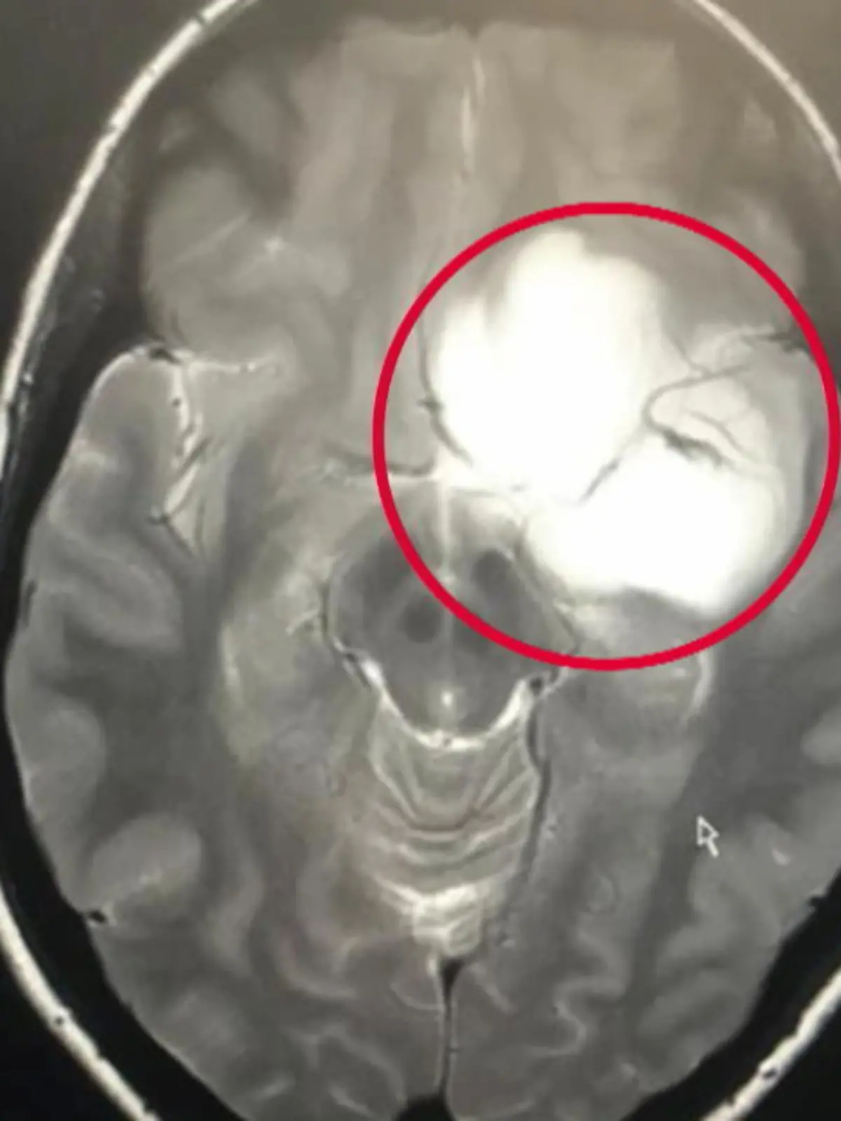 Über 20 Jahre lang hat Catherine Wilcockson mit einem Riesen-Tumor im Kopf gelebt. Jetzt wurde sie operiert! Wie es der 37-Jährigen nun geht, erfahren Sie im Video!