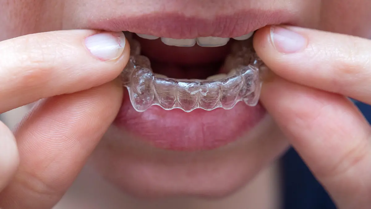 ILLUSTRATION - Eine Frau setzt sich am 02.06.2015 in Berlin eine unsichtbare Zahnspange, eine sogenannte Invisalign-Spange, auf die Zaehne des Unterkiefers. Foto: Andrea Warnecke