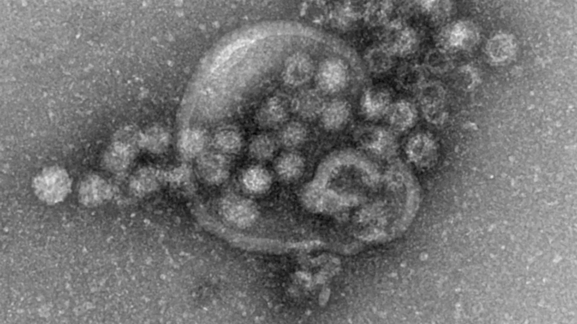 Das Norovirus ist sehr leicht übertragbar und gehört zu den weltweit häufigsten Erregern für plötzlich auftretenden Brechdurchfall.