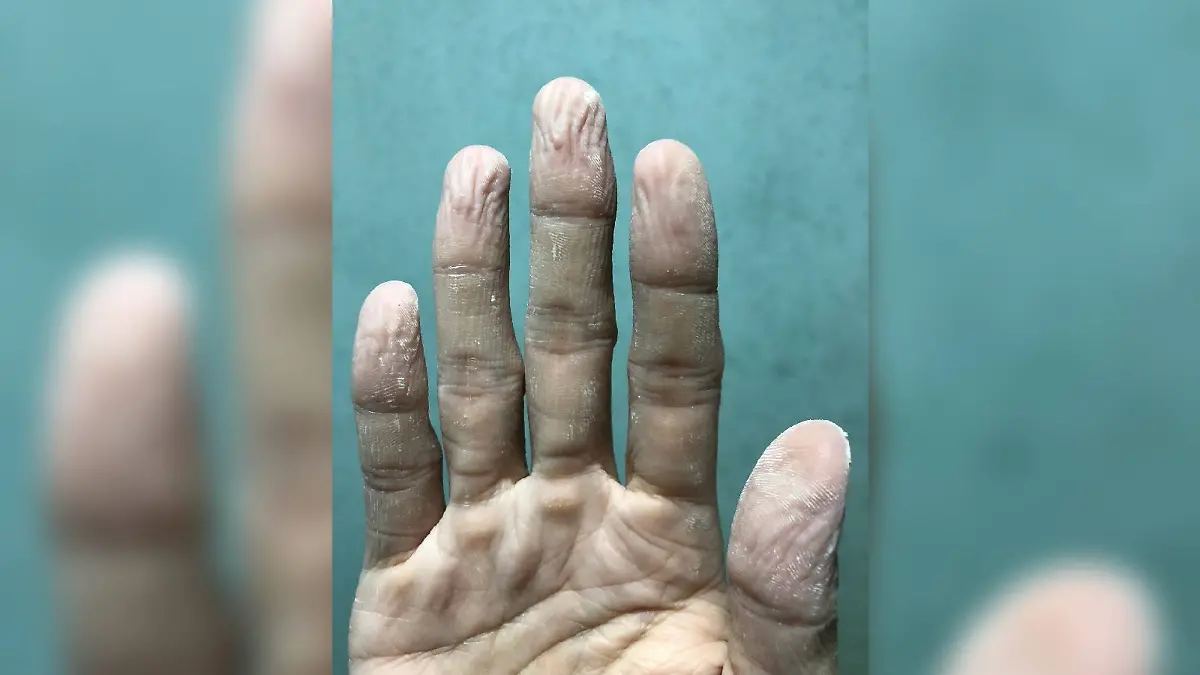 Wer lange im Wasser bleibt, bekommt faltige Fingerspitzen - aber warum?