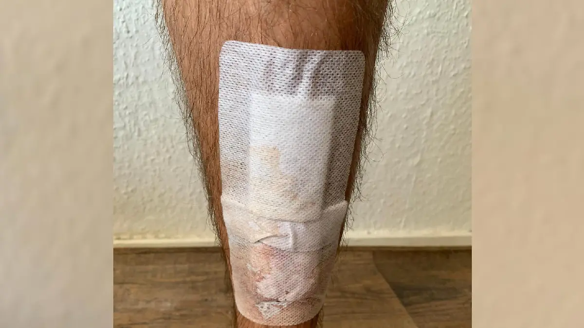 Auch Rafi Racheks Bein hat Blessuren davongetragen.