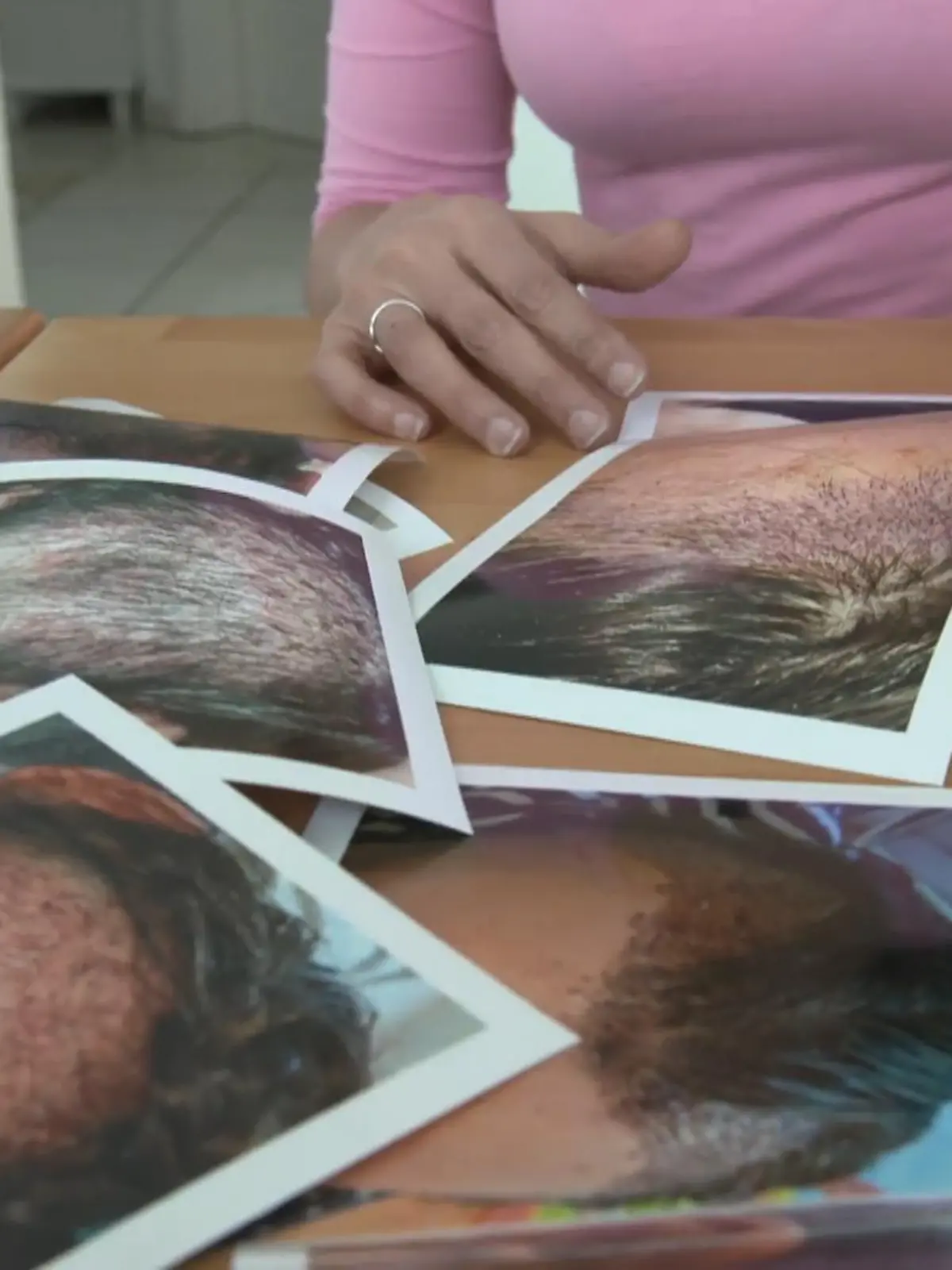 Eigentlich wollte Nina nur ihre leichten Geheimratsecken mit einer Haartransplantation kaschieren lassen, doch der Eingriff geht schief. Nach dem Eingriff in der Türkei entzündet sich ihre Kopfhaut und immer mehr Haare fallen aus.