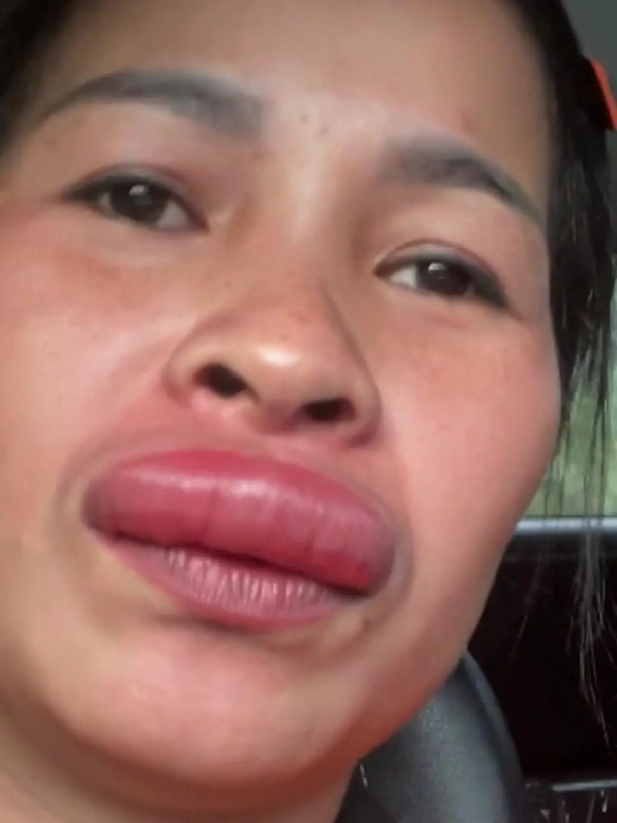 Bild zu: "Neuer Beauty-Trend?! Tierischer Filler beschert Frau XXL-Lippe"