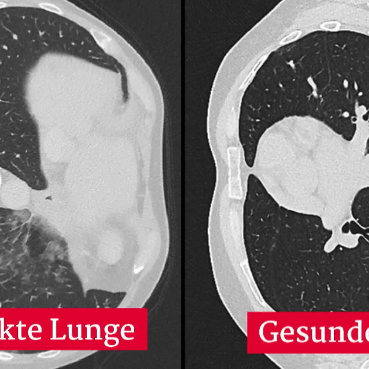 Covid-19 auf dem CT: So sehen Lungen bei Corona-Infektion aus