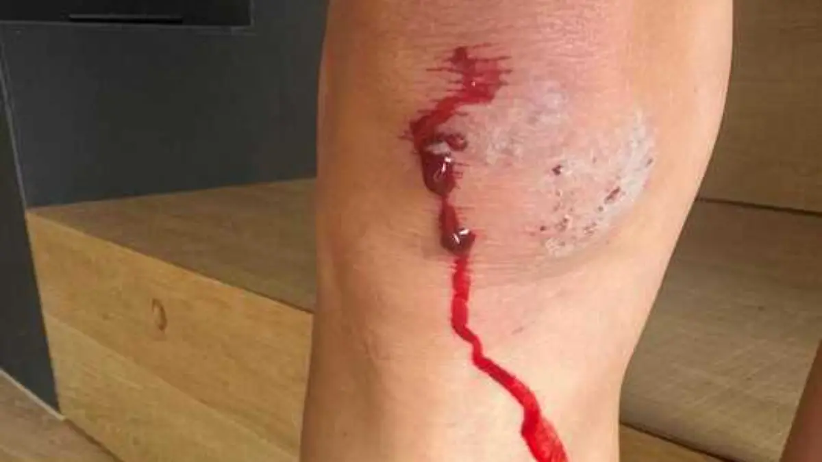 Blut! Cathy Hummels zeigt RTL ihre Wunden