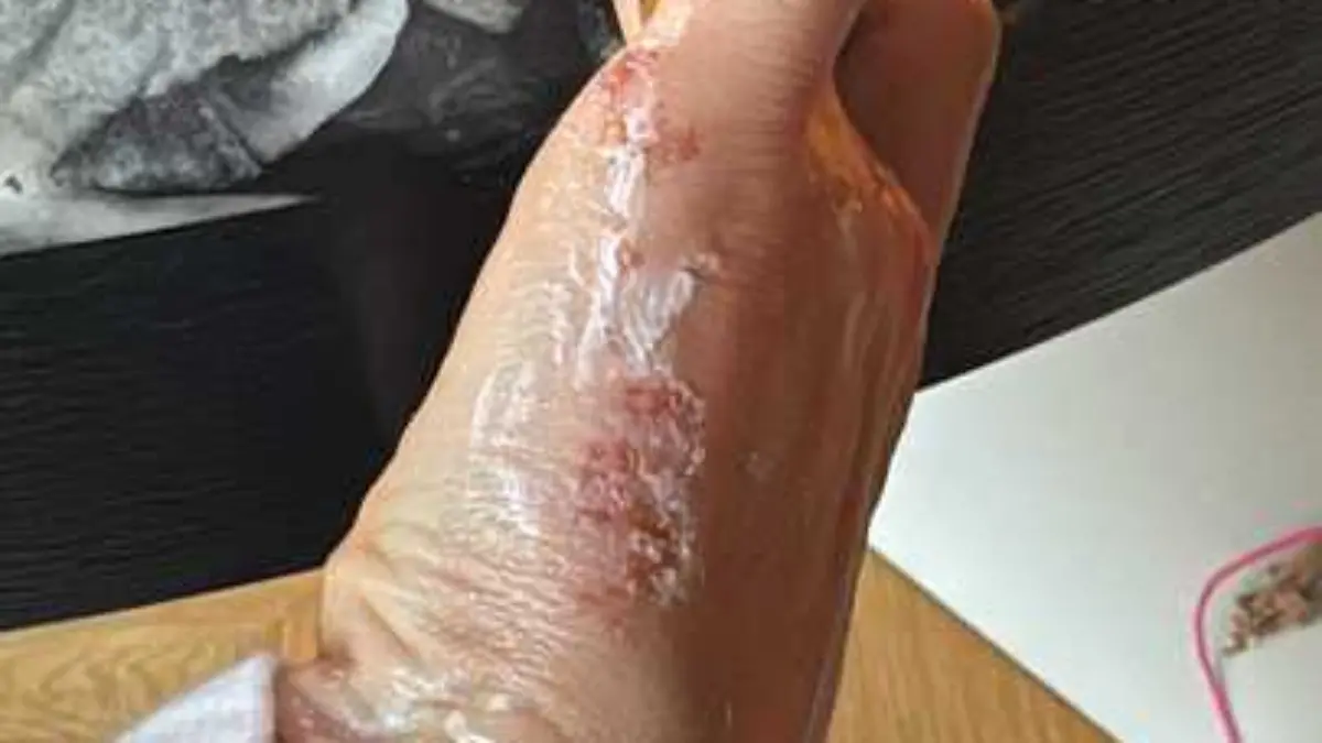 Auch die Hand von Cathy ist ganz dick. Am Freitag geht es ins MRT.
