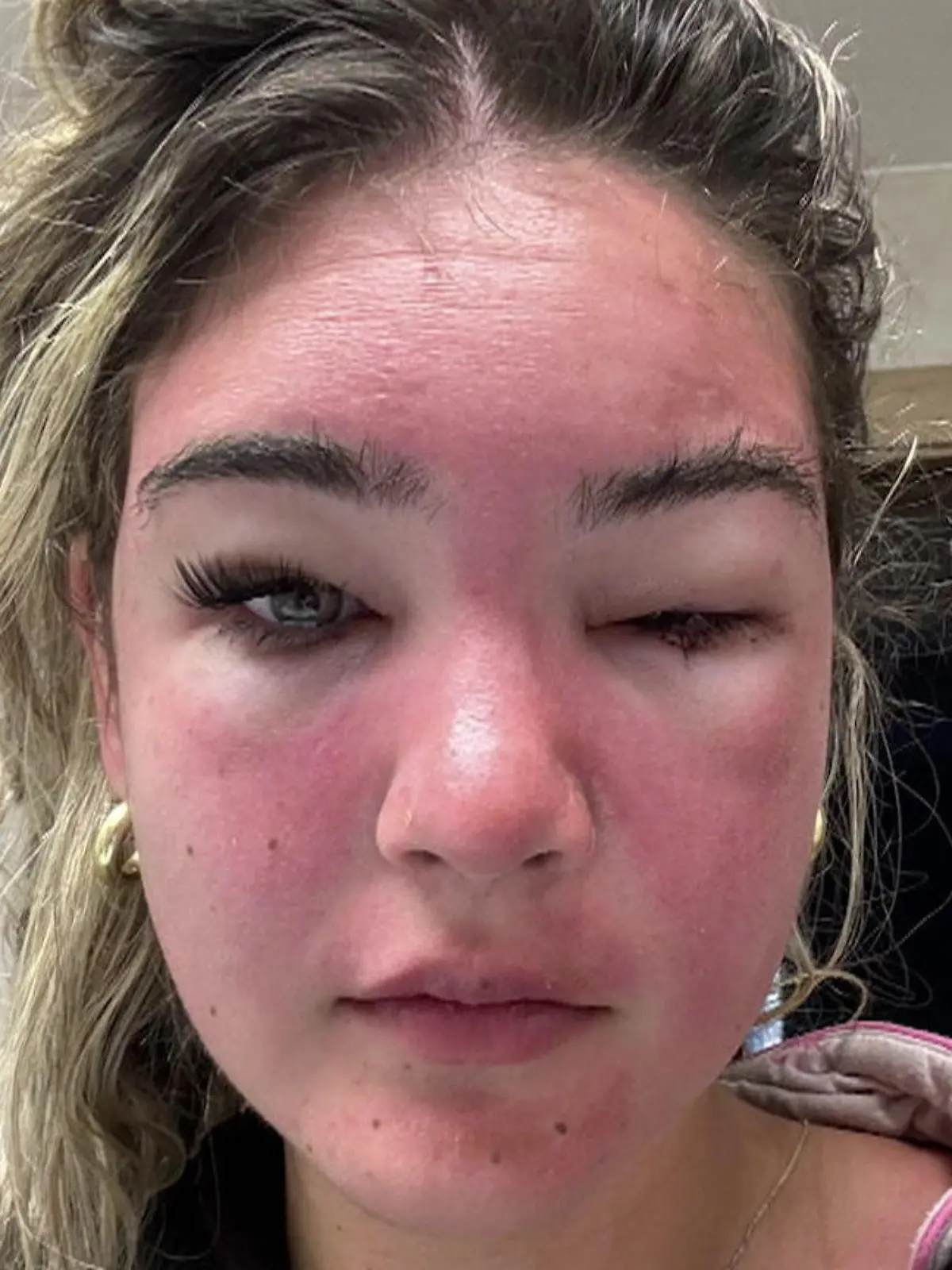 Bild zu: "„Dachte, ich verliere mein Augenlicht“ – Frau (24) nach Sonnenbad komplett entstellt"