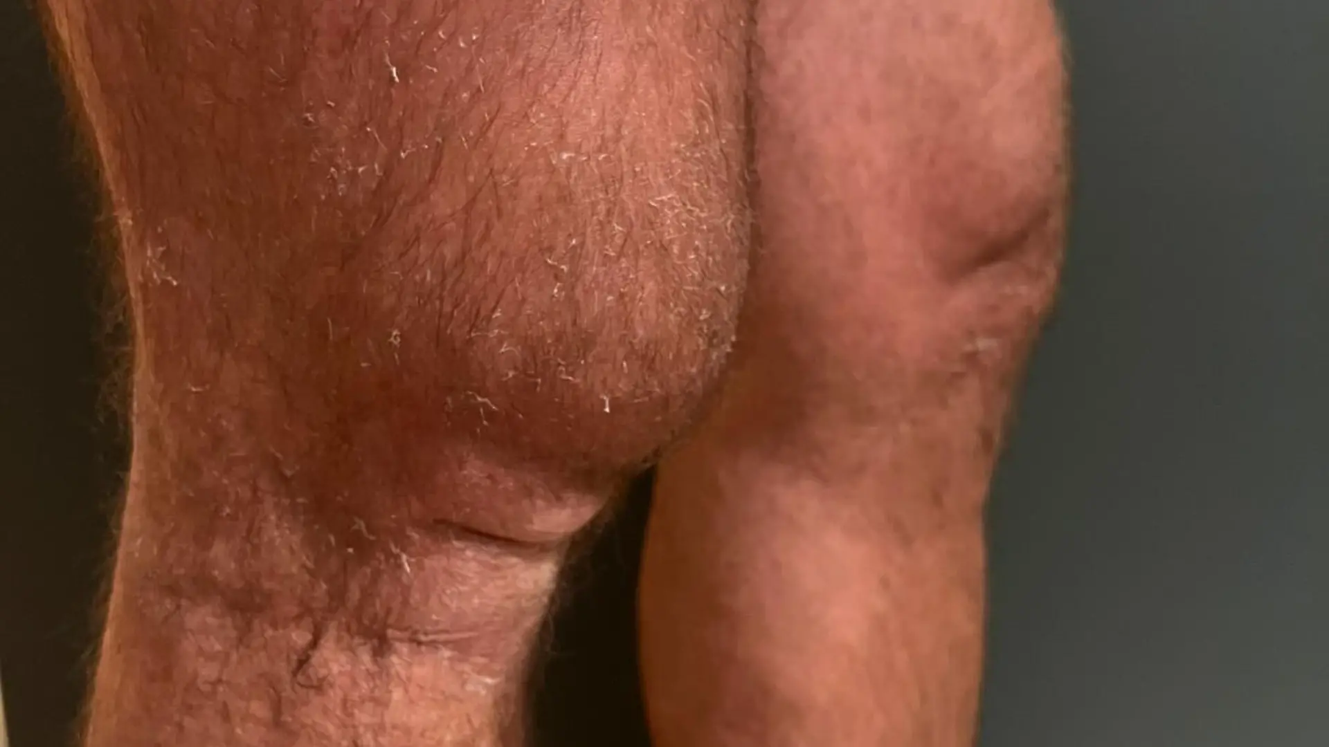 Das Knie von Peter Klein
