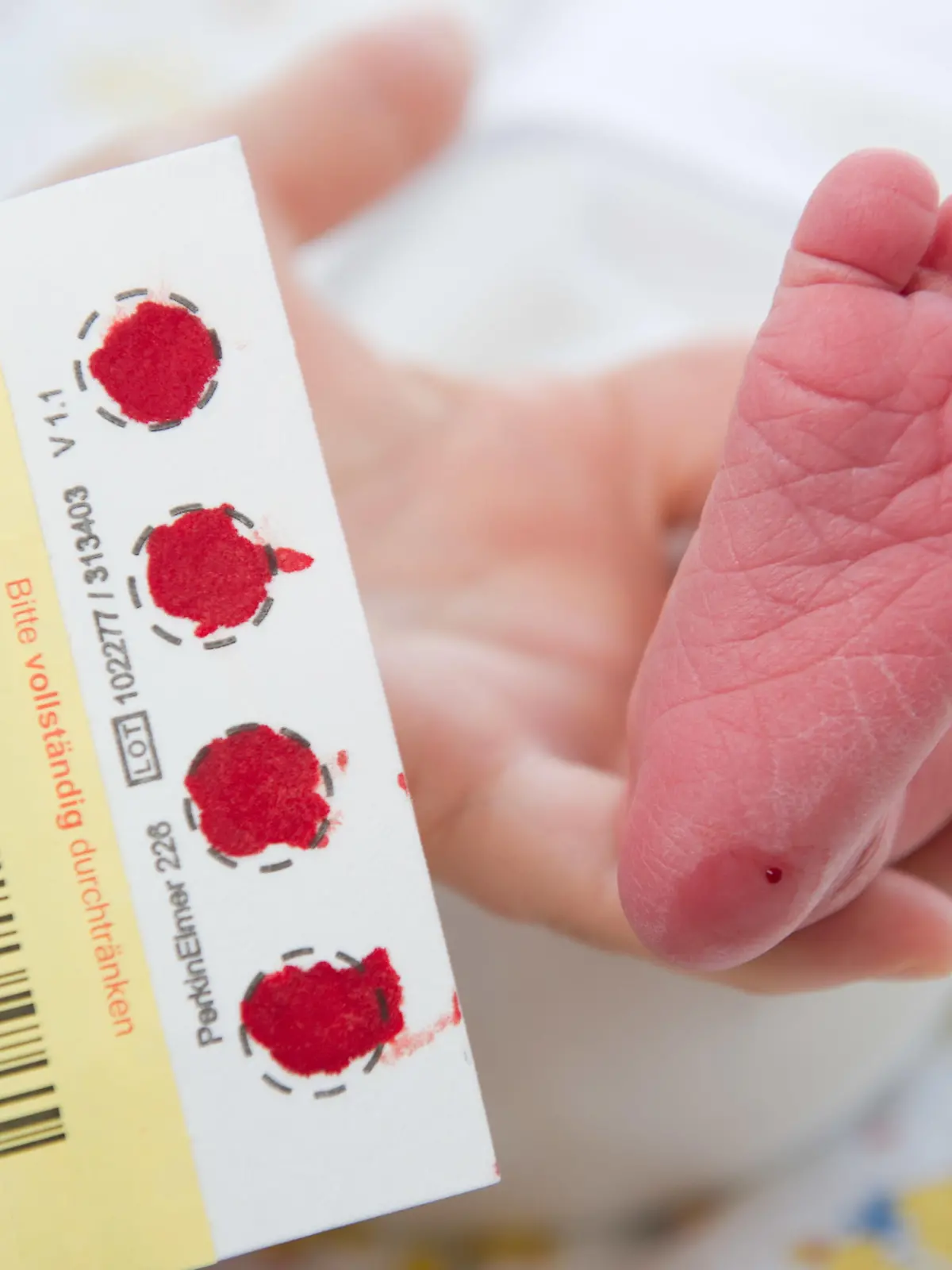 Bluttest beim Neugeborenen-Screening