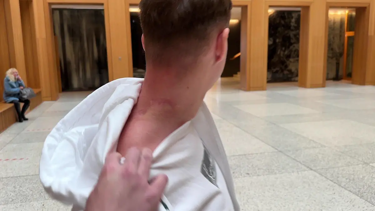 Adrian zeigt seine schlimmen Narben.