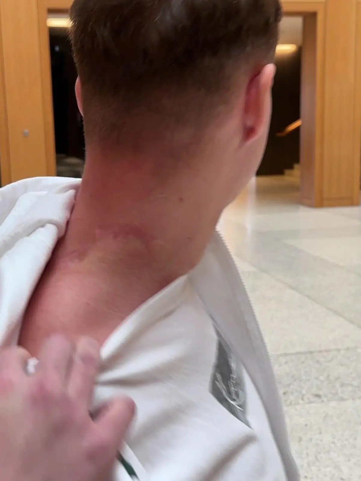 Adrian zeigt seine schlimmen Narben.